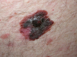 Melanoma de extensión superficial 3