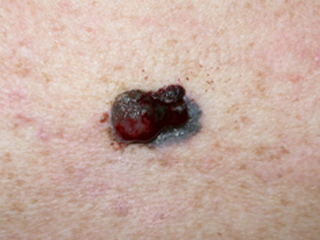 Melanoma de extensión superficial 4