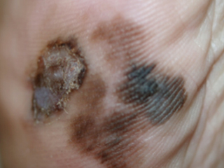 Melanoma lentiginoso acral 1