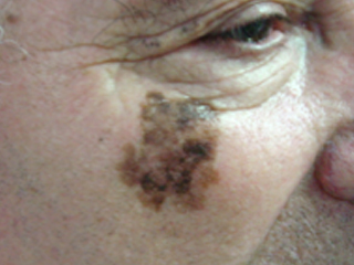 Melanoma Léntigo Maligno 1