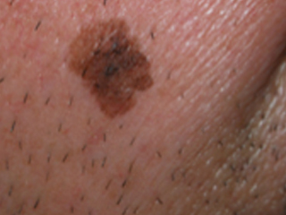 Melanoma Léntigo Maligno 3