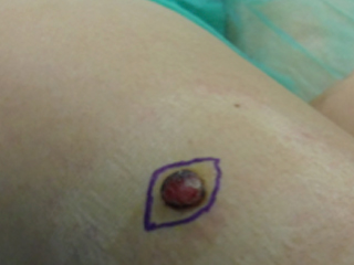 Melanoma nodular 1